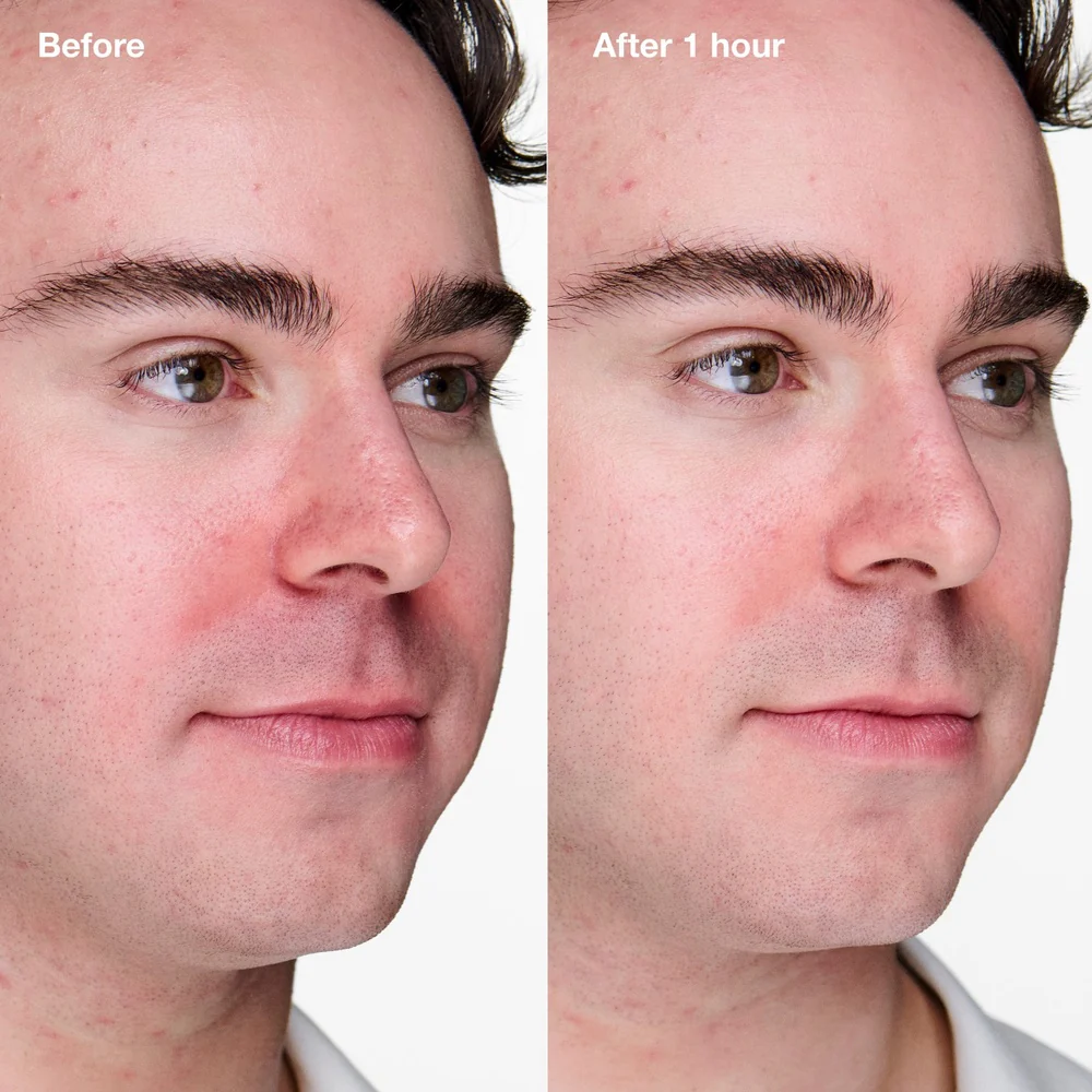 Anti-Blemish Solutions Clinical™ Advanced Clearing Gel żel przeciw niedoskonałościom skóry 20ml - Image 5