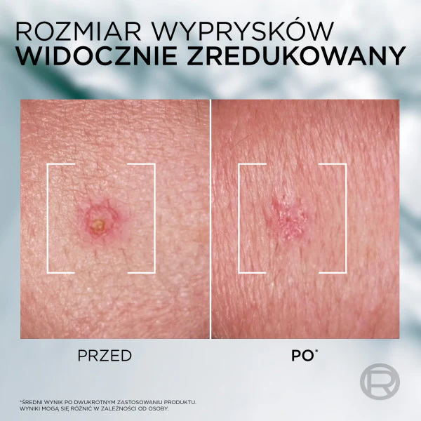 Men Expert Derma Control punktowa pasta na niedoskonałości 45ml - Image 4